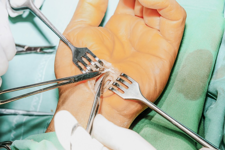 carpel surgery.jpg