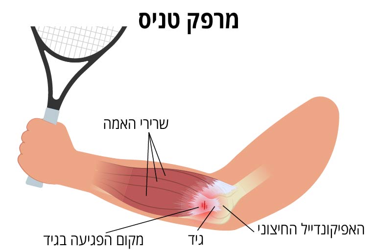 מקום הפגיעה במרפק טניס
