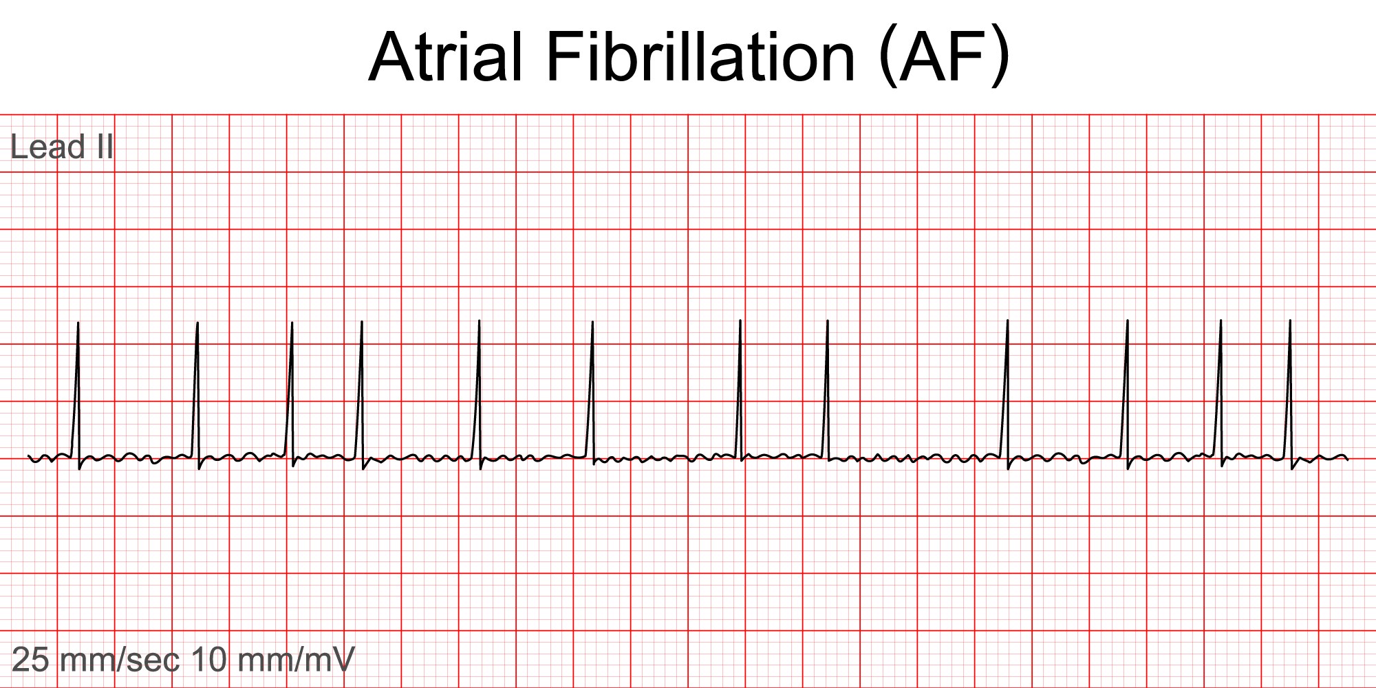 atrial_fibrillation.jpg
