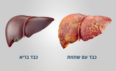 כבד עם שחמת לעומת כבד בריא