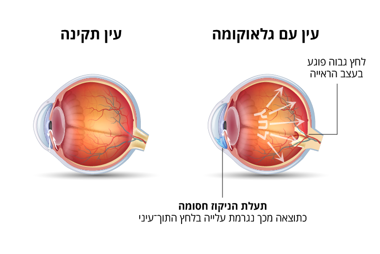 what_causes_glaucoma.png