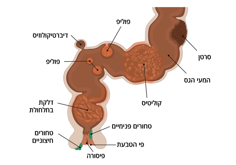 איור של המעי הגס ופי הטבעת עם בעיות שונות שעלולות לגרום לדימום רקטלי