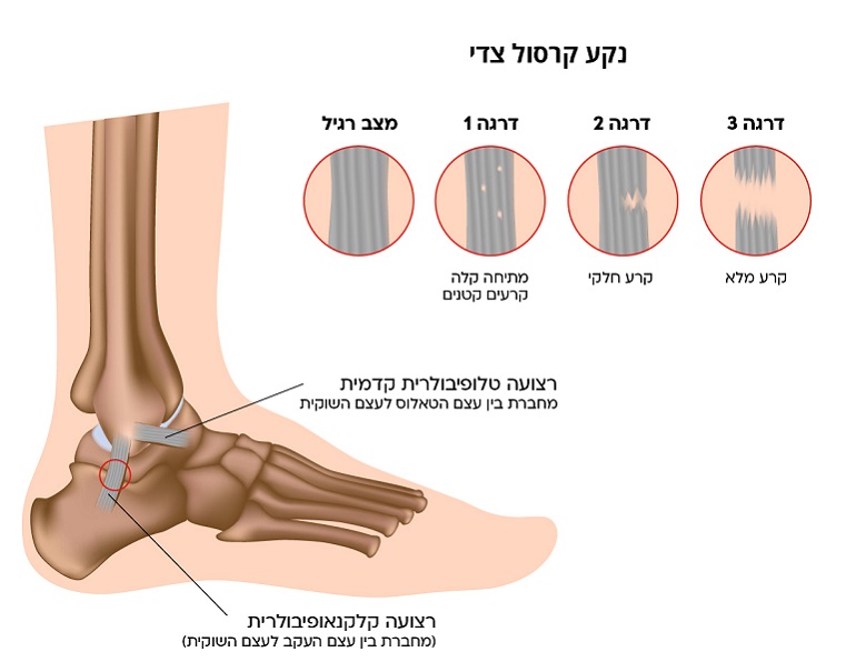 ankle sprain.jpg