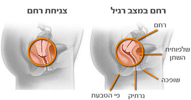 רחם במצב רגיל לעומת רחם במצב של צניחת רחם