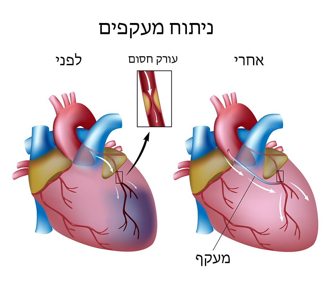 איור של עורק לפני ואחרי ניתוח מעקפים