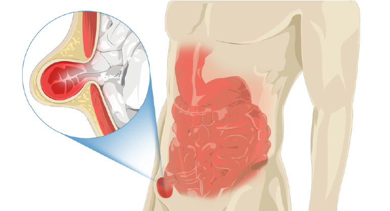 الفتق البطني اعراض اعراض فتق