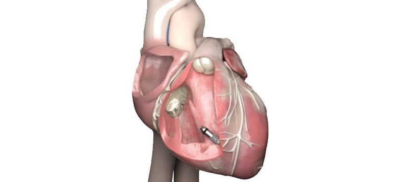 leadless_pacemaker.png