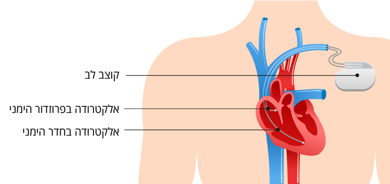 קוצב לב מלאכותי