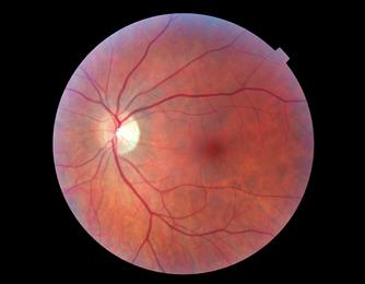 اعتلال الشبكية السكري (Diabetic Retinopathy)