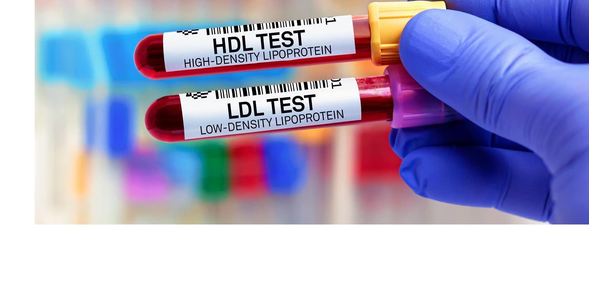 מעבדות ובהן דגימות דם לבדיקות HDL ו־LDL