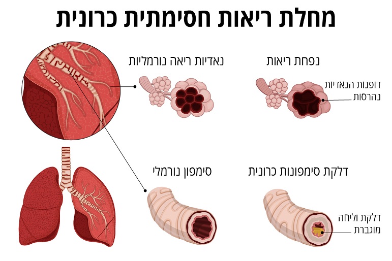 איור שמציג את המאפיינים של מחלות ריאה חסימתיות כרוניות: דפנות הרוסות של נאדיות ריאה וסימפון מודלק לעומת נאדיות ריאה בריאות וסימפ