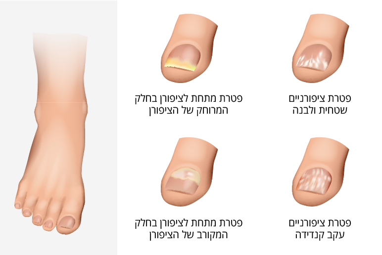 סוגים שונים של פטרת ציפורניים