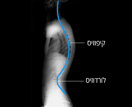 ליקוי יציבה מסוג היפר קיפוזיס