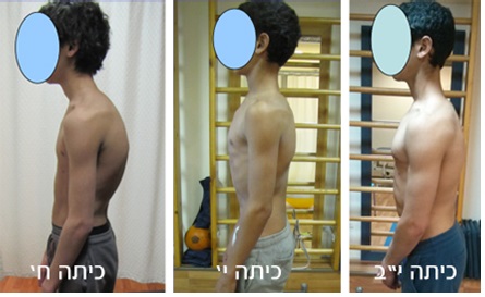 נער לפני ואחרי טיפול פיזיותרפי