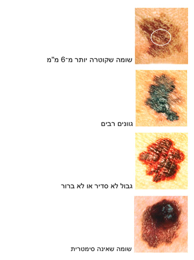 סימנים מחשידים למלנומה