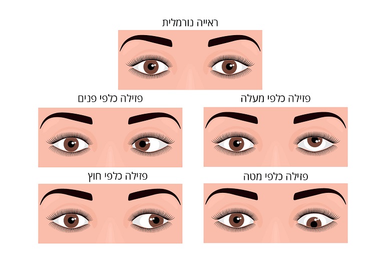 סוגים שונים של פזילות
