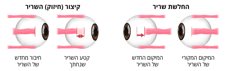 ניתוח לקיצור שריר העין ולהרפייתו