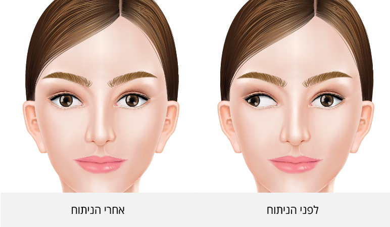 עין לפני ניתוח פזילה ולאחריו