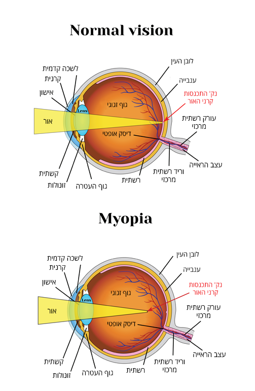 ראייה תקינה לעומת מיופיה