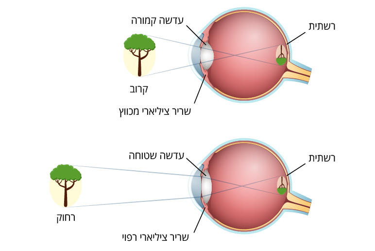 presbyopia.png
