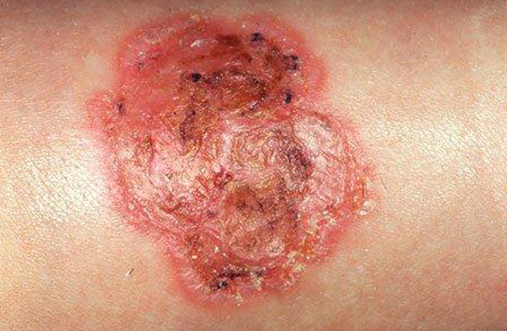 phototake_impetigo_skin_lesion.png