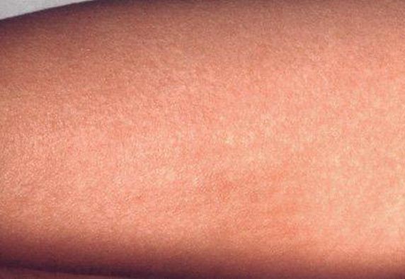scarlet-fever.jpg