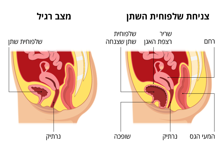 cystocele_drawing.png