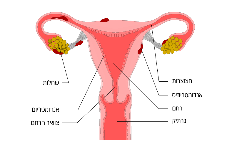 איור של התפשטות נגעי אנדומטריוזיס